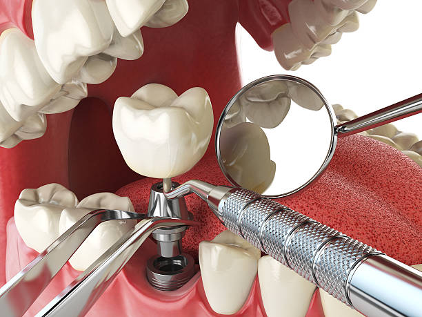 Best Emergency Root Canal Treatment in Reedurban, OH